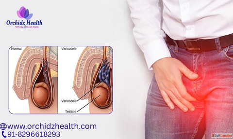 Best Varicocele Treatment in Bangalore for Men at Orchidz Health