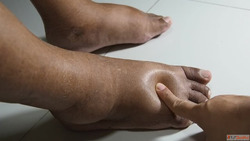 Advanced Diabetic Foot Treatment in Mumbai India by Dr. Dhar...