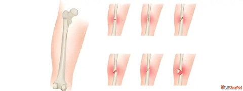 Expert Orthopedic Trauma Fracture Surgery Specialists