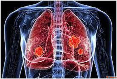 Homeopathic Treatment for Lung Cancer in Agra Dr. Ankur Prakash