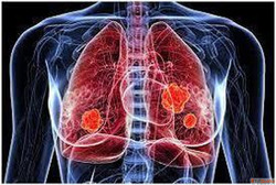 Homeopathic Treatment for Lung Cancer in Agra Dr. Ankur Prak...