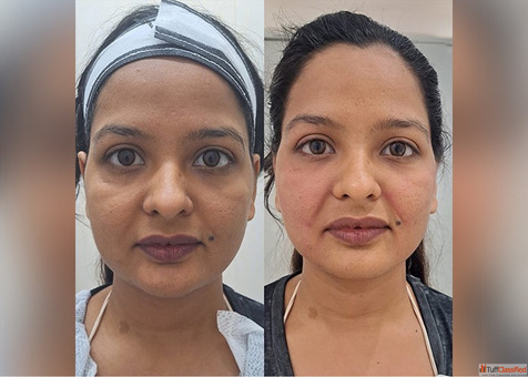 Face Lifting Treatment - Restore Youthful Confidence