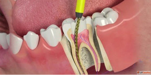 Genuine Cost for Dental Implants in India