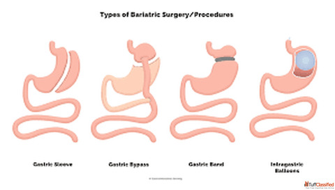 Gastric Sleeve Surgery in Ahmedabad - Safe Effective Weight Loss Solution