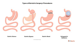 Gastric Sleeve Surgery in Ahmedabad - Safe Effective Weight ...