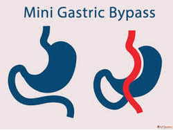 Mini Gastric Bypass Surgery in Ahmedabad - Advanced Safe Wei...