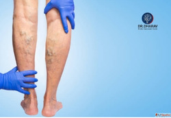 Restore Healthy Legs with Varicose Veins Treatment in Mumbai...