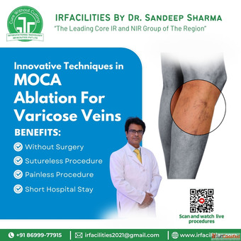 Varicose Veins Treatment Cost Affordable Options