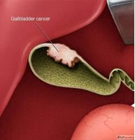 Consult Dr. Shankar Zanwar for Advanced Gallbladder Cancer T...