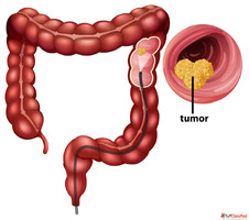 Dr. Shankar Zanwar - Best Treatment for Colon Cancer in Mumb...