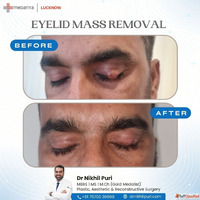 Hair Transplant in Lucknow Dr. Nikhilpuri Natural Permanent ...