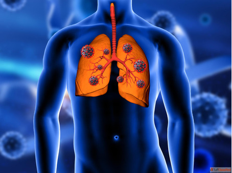 Effective Remedies and Homeopathic Treatment for Lung Cancer