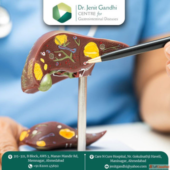 Consult Dr. Jenit Gandhi for Best Liver Cancer Treatment in Ahmedabad India