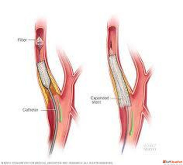 Carotid Artery Stenting Technique Indications and Clinical Outcomes