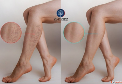 Restore Healthy Comfortable Legs with Dr. Dharav Kheradia - Varicose Veins Treatment in Mumbai