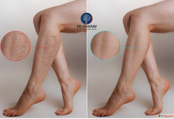 Restore Healthy Comfortable Legs with Dr. Dharav Kheradia - ...