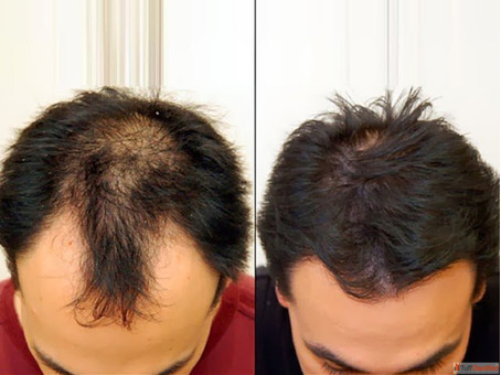 Best Hair transplants Yorkshire clinic