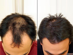 Best Hair transplants Yorkshire clinic