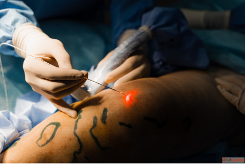 Your Guide to Finding the Best Varicose Veins Doctor