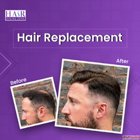 Hair Replacement for Men - Regain Your Confidence Today