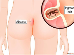 Pilonidal Sinus Treatment In Bangalo