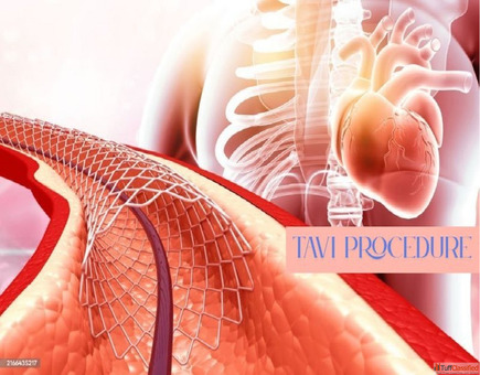 TAVI Procedure in India