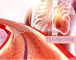 TAVI Procedure in India