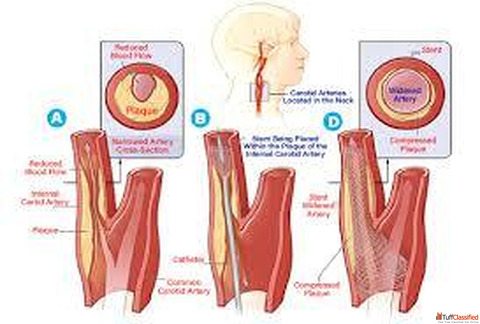 Carotid Artery Stenting State of the Art and Future Directions