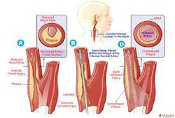 Carotid Artery Stenting State of the Art and Future Directio...