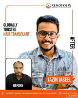 Xenofolix Hair Transplant Clinic in Kerala - Advanced Hair R...