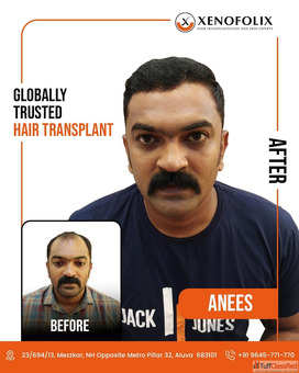 Xenofolix Hair Transplant Clinic in Kerala - Advanced Hair Restoration Treatments