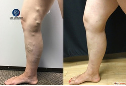 Dr. Dharav Kheradia - Safe Effective Varicose Veins Treatmen...