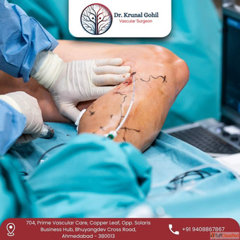 Choose the Best Vascular Surgeon in India for Safe and Painless Treatment