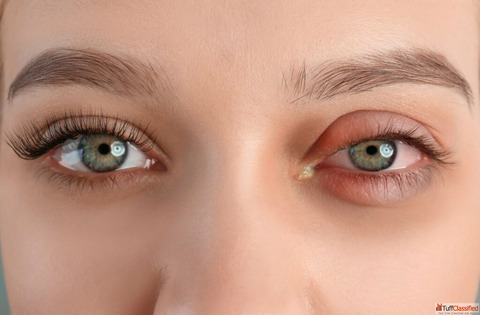 Heal Pink Eye with Homeopathic Treatment for Conjunctivitis