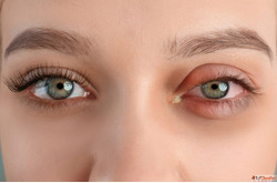 Heal Pink Eye with Homeopathic Treatment for Conjunctivitis