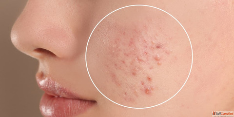 Say Goodbye to Skin Issues with Homeopathy Treatment