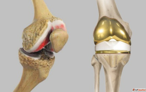 Knee Doctor in Gorakhpur