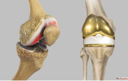 Knee Doctor in Gorakhpur