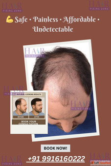 Non-Surgical Hair Fixing for Male Pattern Baldness 100 Natural Look"