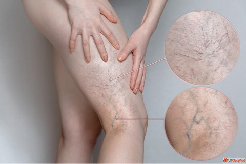 Best Hospital for Varicose Vein Treatment in India - Advanced Effective Care