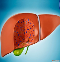Dr. Chetan Kalal - Best Treatment for Fatty Liver in Mumbai