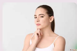 Acne Treatment for Dry Skin