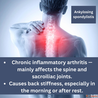 Is Chiropractic Safe for Ankylosing Spondylitis