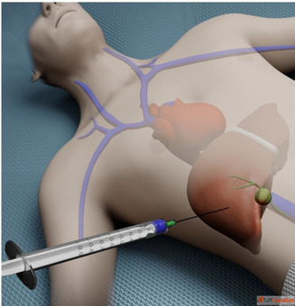 Dr. Chetan Kalal - Best Liver Biopsy Procedure in Mumbai