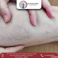 Dr. Krunal Gohil Offers the Best Varicose Veins Treatment in...