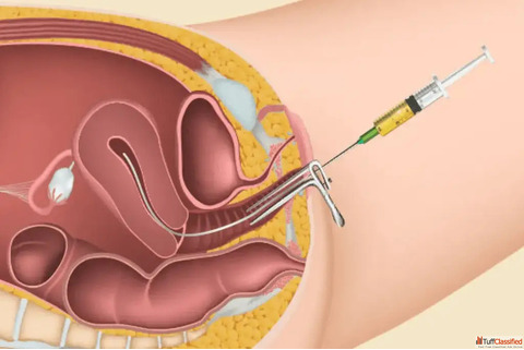 Affordable IUI Treatment in Mumbai Trusted Fertility Experts at Womb IVF