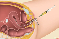 Affordable IUI Treatment in Mumbai Trusted Fertility Experts...