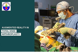 Looking for a Knee Arthroplasty