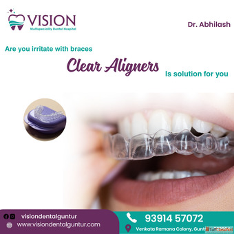 Clear Aligners - A Comfortable Alternative to Braces at Vision Dental Guntur