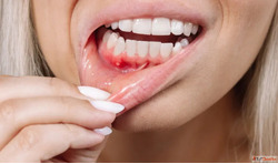 Best Homeopathic Medicine for Mouth Ulcer Relief